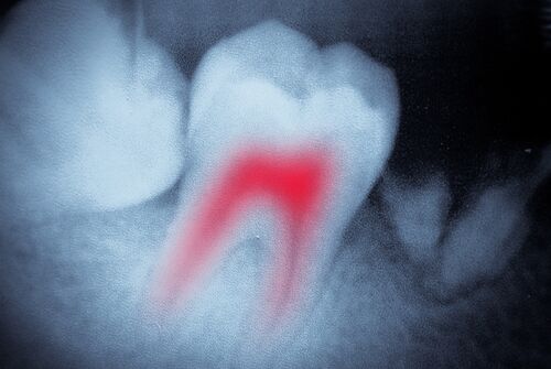 Root Canal Treatment in East Longmeadow, MA | Free Consult
