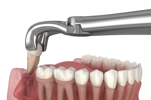 Dental Extraction in East Longmeadow, MA | Free Consultations